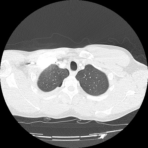 File Traumatic Rib Fractures Pneumothorax And Liver Laceration Radiopaedia Axial
