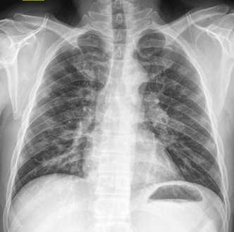 COVID-19 as seen by chest X-ray, CC NC, Radiopaedia