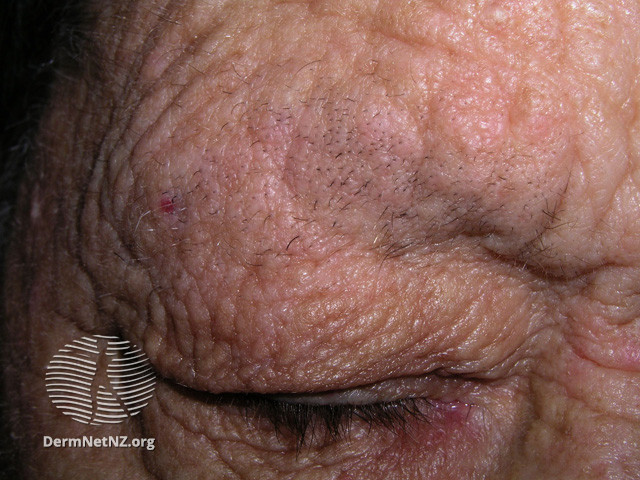 File:(DermNet NZ dermatitis-lichen-simplex-3117).jpg
