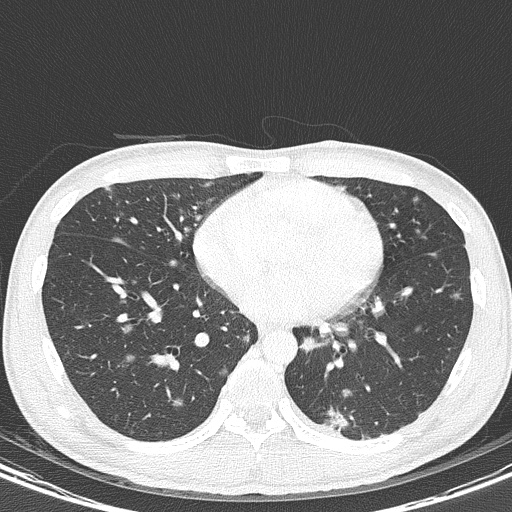 File:AIDS-related Kaposi sarcoma (Radiopaedia 85247-100811 Axial lung window 109).jpg