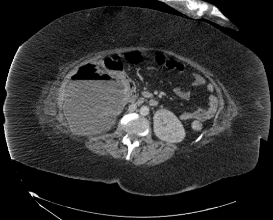 File:Abdominal abscess - pre and post percutaneous drainage (Radiopaedia 60209-67816 Axial 13).png