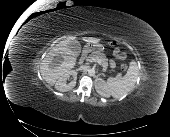 File:Abdominal abscess - pre and post percutaneous drainage (Radiopaedia 60209-67816 Axial 55).png