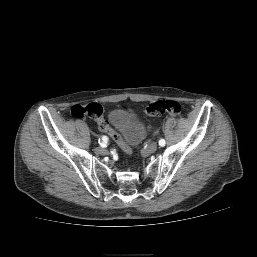 File:Abdominal aortic aneurysm (Radiopaedia 13341-13340 Axial C+ arterial phase 203).jpg