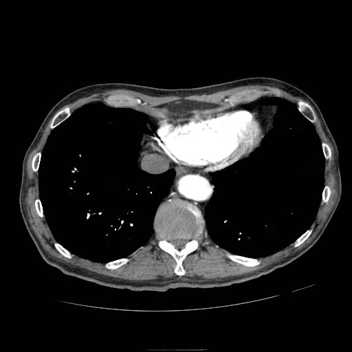Abdominal aortic aneurysm (Radiopaedia 13341-13340 Axial C+ arterial phase 4).jpg