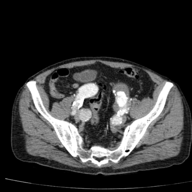 Abdominal aortic aneurysm (Radiopaedia 29248-29660 Axial C+ arterial phase 70).jpg