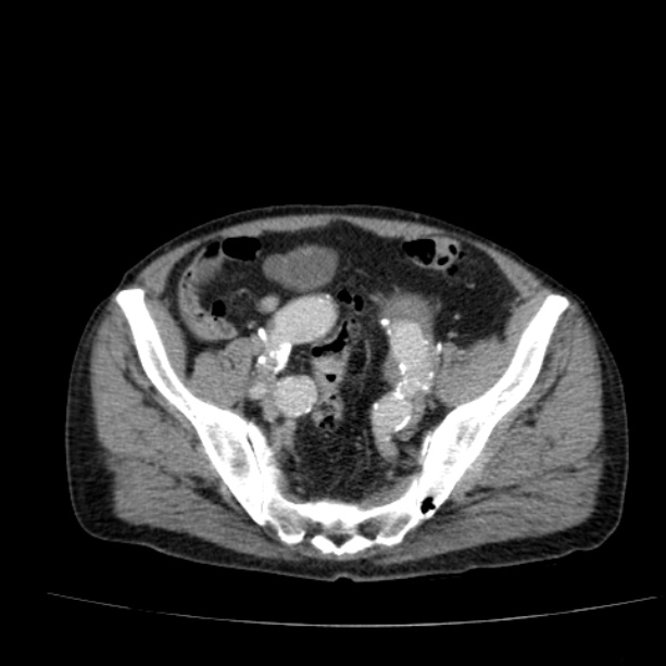 Abdominal aortic aneurysm (Radiopaedia 29248-29660 Axial C+ portal venous phase 49).jpg