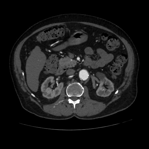 File:Abdominal aortic aneurysm (Radiopaedia 57318-64259 Axial C+ arterial phase 29).jpg
