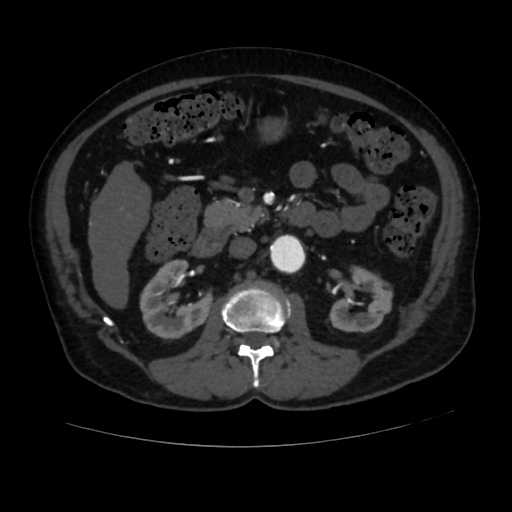 File:Abdominal aortic aneurysm (Radiopaedia 57318-64259 Axial C+ arterial phase 30).jpg