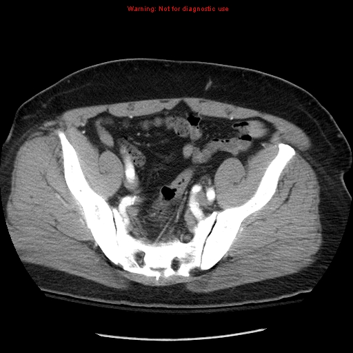 Abdominal aortic aneurysm (Radiopaedia 8190-9038 Axial C+ arterial phase 67).jpg