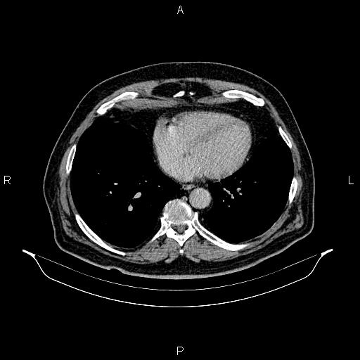 Abdominal aortic aneurysm (Radiopaedia 83094-97462 Axial renal excretory phase 5).jpg