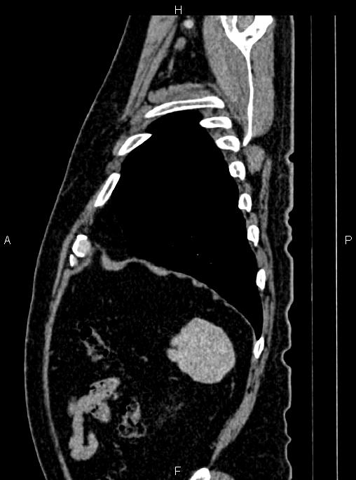 Abdominal aortic aneurysm (Radiopaedia 83094-97462 Sagittal renal cortical phase 105).jpg