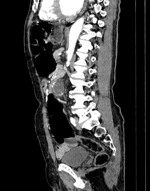 Abdominal aortic aneurysm (Radiopaedia 83581-98689 Sagittal C+ arterial phase 60).jpg
