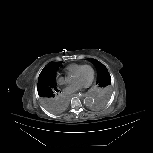 Abdominal aortic aneurysm - impending rupture (Radiopaedia 19233-19247 Axial non-contrast 15).jpg