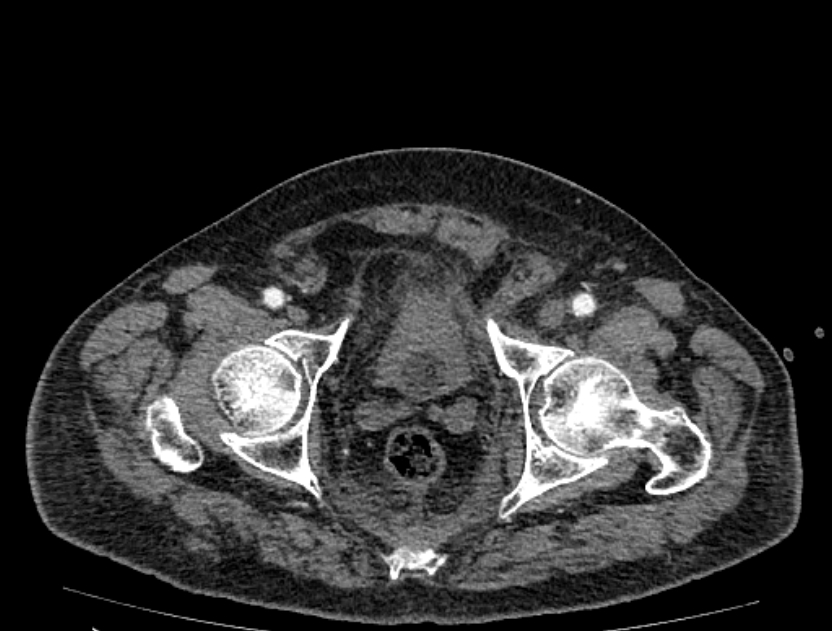 Abdominal aortic aneurysm rupture (Radiopaedia 54179-60362 Axial C+ portal venous phase 1).jpg