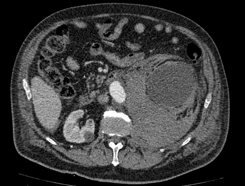 Abdominal aortic aneurysm rupture (Radiopaedia 54179-60362 Axial C+ portal venous phase 23).jpg