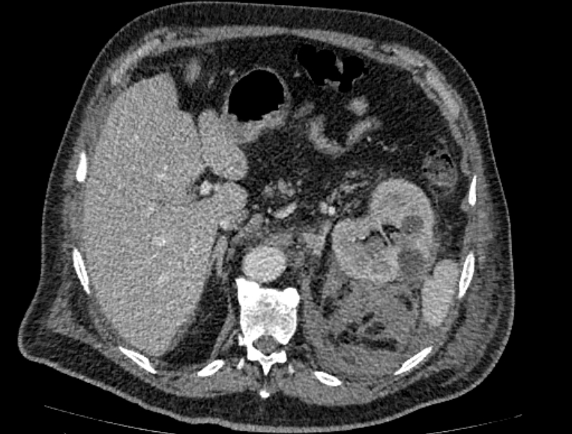 Abdominal aortic aneurysm rupture (Radiopaedia 54179-60362 Axial C+ portal venous phase 30).jpg