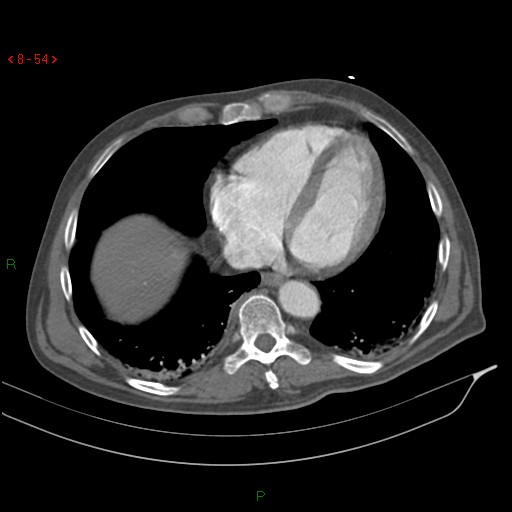 Abdominal aortic aneurysm rupture with aortocaval fistula (Radiopaedia 14897-14841 Axial C+ arterial phase 54).jpg