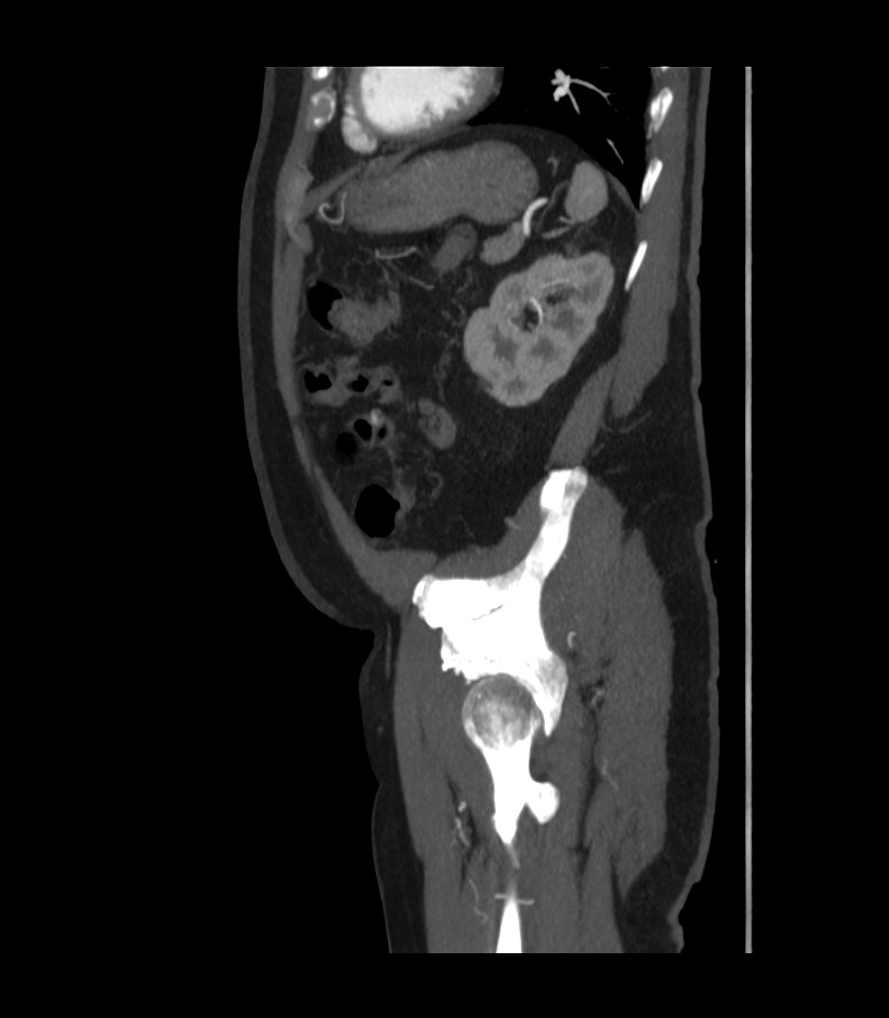 Abdominal aortic aneurysm with thrombus fissuration (Radiopaedia 46218-50618 Sagittal C+ arterial phase 47).jpg