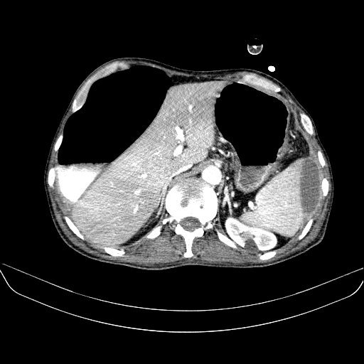 File:Abdominal collection due to previous cecal perforation (Radiopaedia 80831-94320 Axial C+ portal venous phase 49).jpg