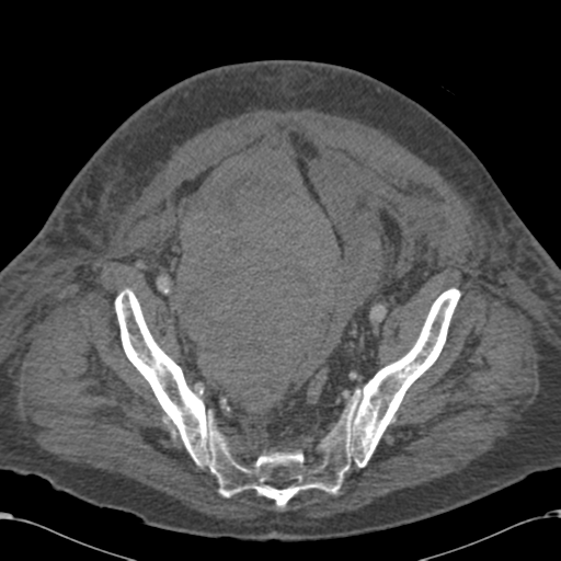 Abdominal hematoma (Radiopaedia 33614-34715 Axial C+ portal venous phase 108).png