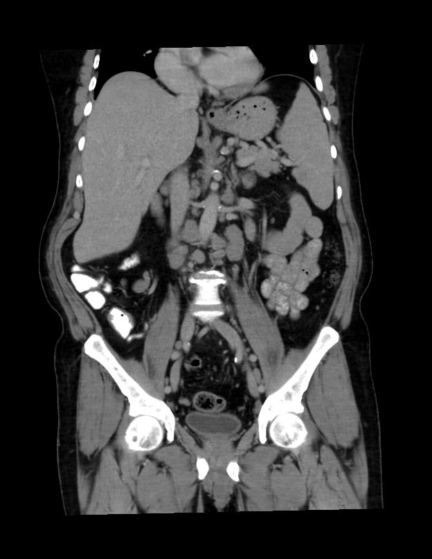 Abdominal lymphoma - with sandwich sign (Radiopaedia 53486-59492 C+ portal venous phase 28).jpg
