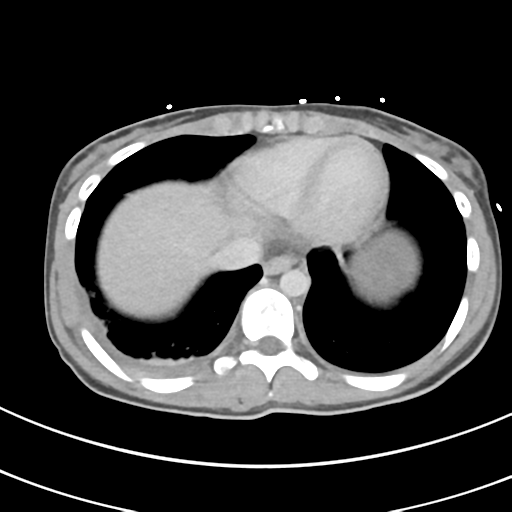 File:Abdominal multi-trauma - devascularised kidney and liver, spleen and pancreatic lacerations (Radiopaedia 34984-36486 Axial C+ delayed 4).png