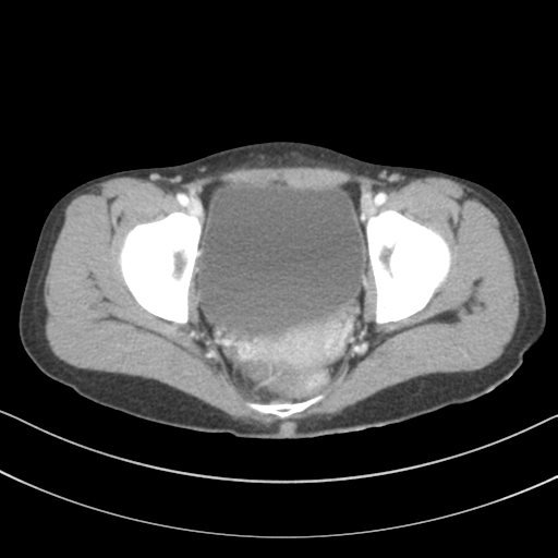 File:Abdominal multi-trauma - devascularised kidney and liver, spleen and pancreatic lacerations (Radiopaedia 34984-36486 Axial C+ portal venous phase 76).png