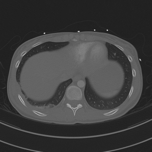 Abdominal multi-trauma - devascularised kidney and liver, spleen and pancreatic lacerations (Radiopaedia 34984-36486 I 68).png