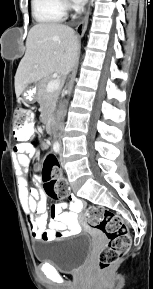 Abdominal wall and retroperitoneal tuberculosis (Radiopaedia 88137-104729 Sagittal C+ portal venous phase 77).jpg