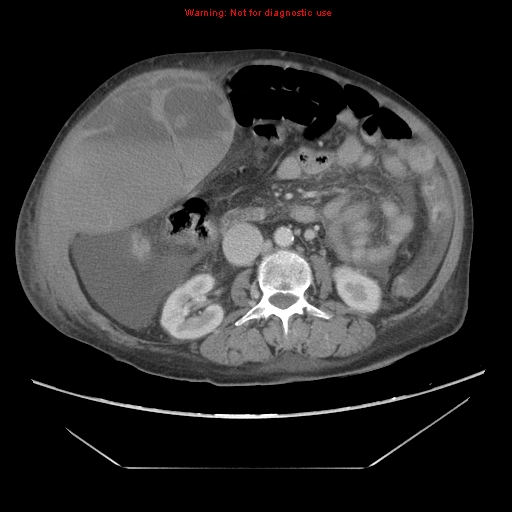 File:Abdominal wall hematoma (Radiopaedia 9427-10112 Axial C+ portal venous phase 49).jpg