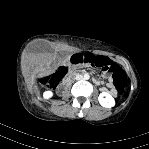 Abdominal wall hematoma with active bleeding (Radiopaedia 83915-99117 Axial C+ portal venous phase 37).jpg