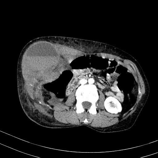 File:Abdominal wall hematoma with active bleeding (Radiopaedia 83915-99117 Axial renal cortical phase 39).jpg