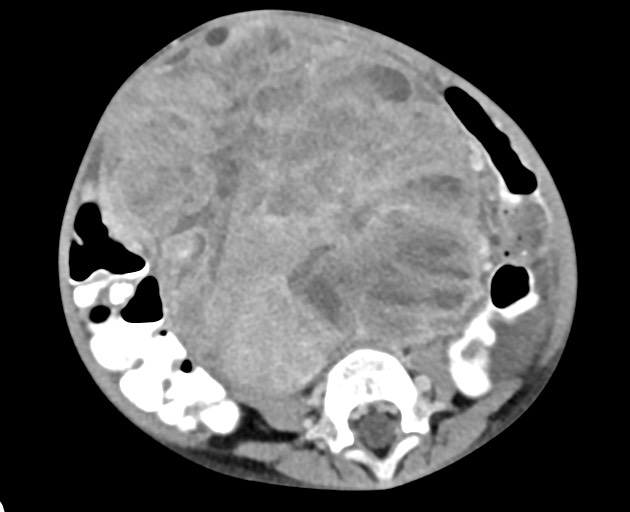 File:Abdominopelvic rhabdomyosarcoma (Radiopaedia 78356-90984 Axial C+ portal venous phase 108).jpg
