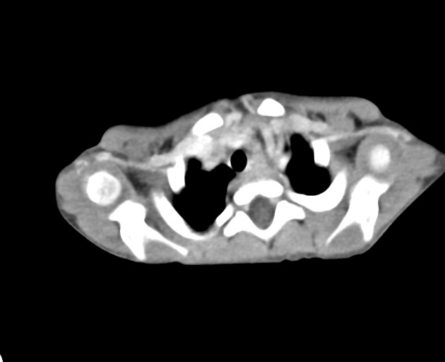 Abdominopelvic rhabdomyosarcoma (Radiopaedia 78356-90984 Axial C+ portal venous phase 3).jpg