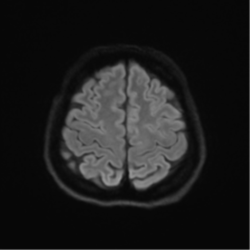 File:Abducens nerve palsy (Radiopaedia 51069-56648 Axial DWI 49).png