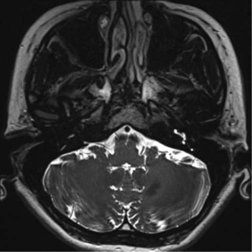 Abducens nerve palsy (Radiopaedia 51069-56648 Axial T2 fat sat 10).png