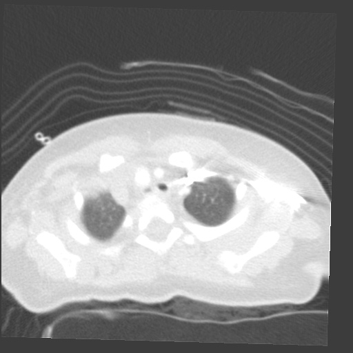 File:Aberrant left pulmonary artery (pulmonary sling) (Radiopaedia 42323-45435 Axial lung window 5).jpg