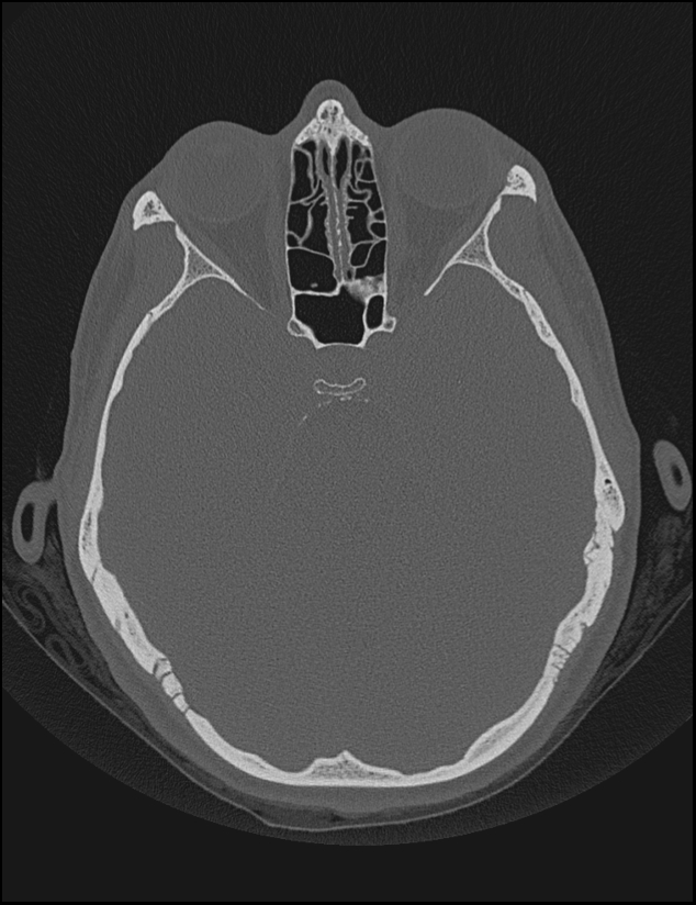 Aberrant right internal carotid artery (Radiopaedia 65191-74198 Axial non-contrast 67).jpg