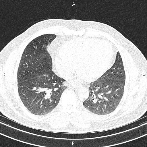 File:Aberrant right subclavian artery (Radiopaedia 87093-103354 Axial lung window 74).jpg