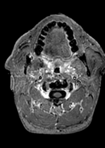 Accessory middle cerebral artery (Radiopaedia 73114-83828 Axial T1 C+ 233).jpg