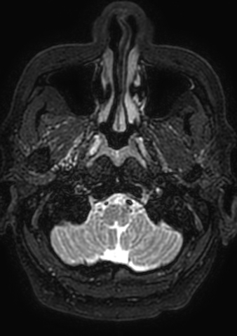 Accessory middle cerebral artery (Radiopaedia 73114-83828 Axial T2 210).jpg