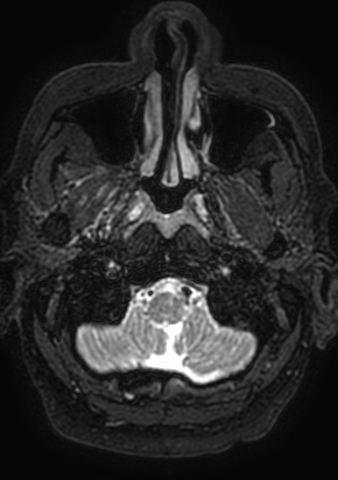 Accessory middle cerebral artery (Radiopaedia 73114-83828 Axial T2 213).jpg