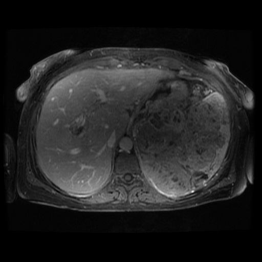Acinar cell carcinoma of the pancreas (Radiopaedia 75442-86668 Axial T1 C+ fat sat 103).jpg