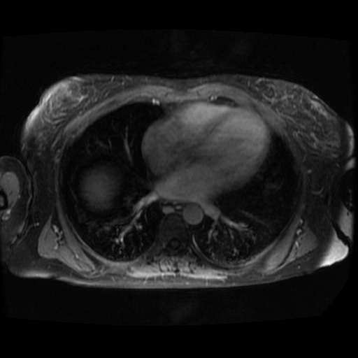 Acinar cell carcinoma of the pancreas (Radiopaedia 75442-86668 Axial T1 C+ fat sat 147).jpg