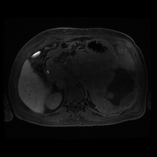 Acinar cell carcinoma of the pancreas (Radiopaedia 75442-86668 Axial late phase (~30 mins) 70).jpg