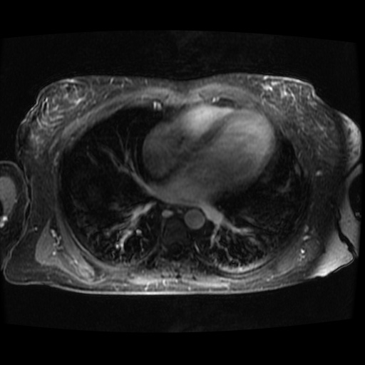 Acinar cell carcinoma of the pancreas (Radiopaedia 75442-86668 D 148).jpg