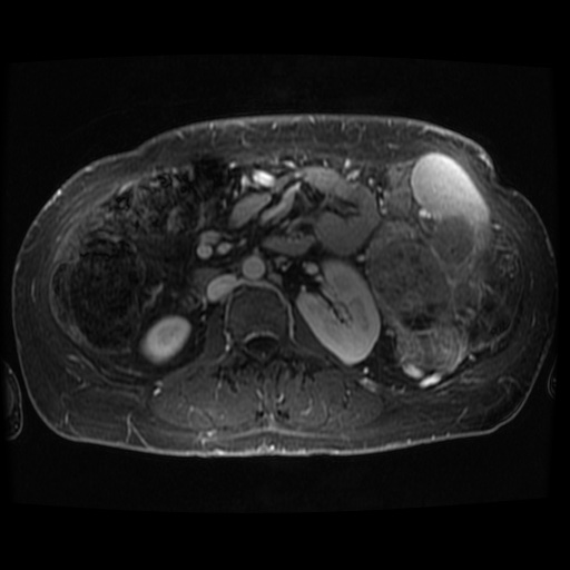 Acinar cell carcinoma of the pancreas (Radiopaedia 75442-86668 D 24).jpg