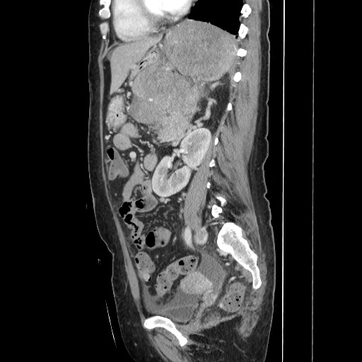 File:Acinar cell carcinoma of the pancreas (Radiopaedia 75442-86669 Sagittal C+ portal venous phase 116).jpg