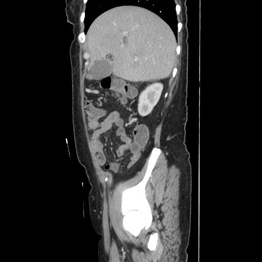File:Acinar cell carcinoma of the pancreas (Radiopaedia 75442-86669 Sagittal C+ portal venous phase 56).jpg
