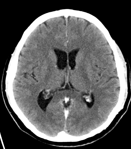 File:Acoustic schwannoma (Radiopaedia 33045-34065 Axial C+ delayed 14).png
